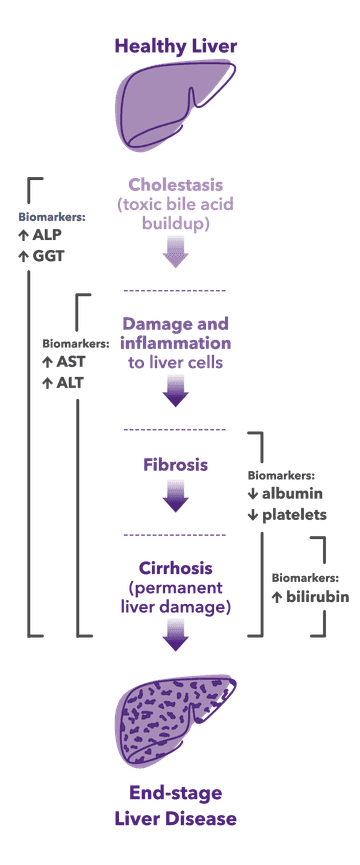 Key biomarkers of PBC progression